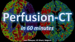 Perfusion-CT in acute ischemic stroke (in ~60 minutes)