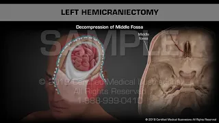 Left Hemicraniectomy - Medical Animation