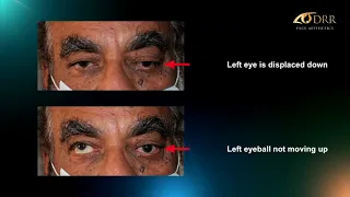 Orbital Tumor Excision Surgery - Treating Bulgy Eye/Proptosis