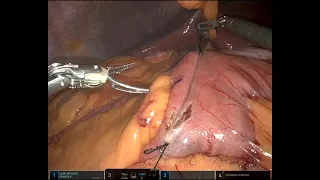 How I do a robotic bypass revision by distalization of Roux limb