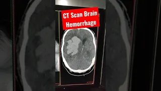 Stroke : Intracranial Hemorrhage CT Scan Brain #shorts #shortsvideo #youtubeshorts