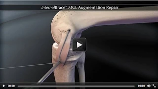 InternalBrace™ MCL Augmentation Repair