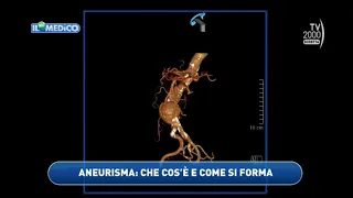 Il Mio Medico (Tv2000) - Come riconoscere, curare e prevenire l’aneurisma