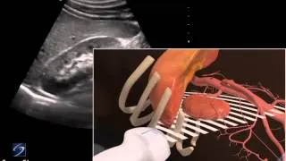 3D How To: Right Kidney Ultrasound - SonoSite Ultrasound