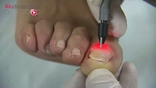 Mycoses des ongles :  le traitement au laser - Allô Docteurs