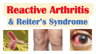 Reactive Arthritis & Reiter’s Syndrome | Causes, Signs & Symptoms, Diagnosis, Treatment