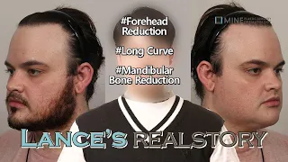 [Plastic Surgery in Korea] Facial contouring + Forehead reduction