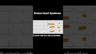 Broken Heart SyndromelTakotsubo Cardiomyopathy #medicine #youtubeshorts #ecgcpo2022 #viral