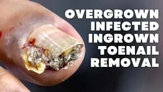 OVERGROWN INFECTED INGROWN TOENAIL REMOVAL ***WITH A SUPER SURPRISE***