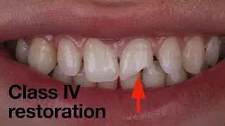 Free hand class IV restoration using simplified approach and unica matrix