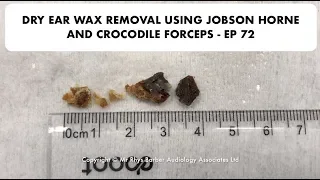 DRY EAR WAX REMOVAL USING JOBSON HORNE AND CROCODILE FORCEPS - EP 72