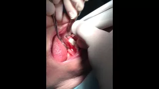 Implant placement by Piezo Technique