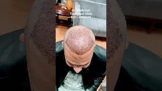 FUE Hair transplant Fresh Case || #drhabibhairtransplant #shorts #hairtransplant2023 #reels