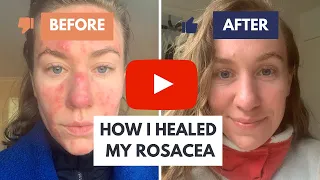 How I Healed My Rosacea: The Solution Dermatologists Don't Want You to Know About!