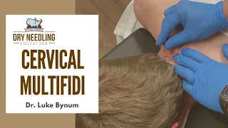 Dry Needling Cervical Multifidi