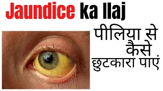 Jaundice ka ilaj | Jaundice ka bimari kaise thik hota hai?