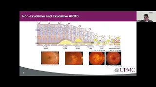 Sight + Sound Bites: AMD Understanding Genetic and Behavioral Risk Factors to Develop New Therapies