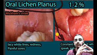 Oral Lichen Planus - Symptoms, Causes, Treatment. Wickham's striae