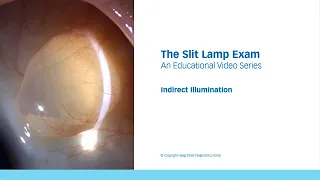 The Slit Lamp Exam – Episode 8, Indirect Illumination