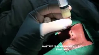 Tapping Dacryocystitis By Dr. Nattawut Wanumkarng, Thailand