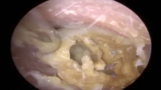 Woman Gets Huge Chunk Of Earwax Removed