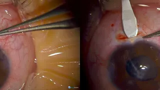 3D Surgery: Secondary IOL in Traumatic Cataract: Dr. Jonathan Song