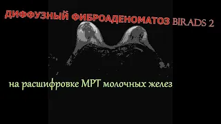 ДИФФУЗНЫЙ ФИБРОАДЕНОМАТОЗ молочных желез BiRADS 2 на расшифровке МРТ