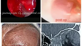 FESS# SUPRAORBITAL CELL disease# superior orbital wall decompression dr s md Siddique MMC ENT