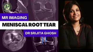 MENISCAL ROOT TEAR | SRIJITA GHOSH | MRI KNEE | MENISCAL TEARS | ROOT AVULSION | KNEE TRAUMA