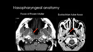 Dr Mamdouh Mahfouz head and neck imaging Supra hyoid neck parapharyngeal spaces