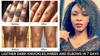 I CLEARED MY DARK KNUCKLES IN 7 DAYS 😳!!/ LIGHTEN YOUR DARK KNUCKLES,ELBOWS AND KNEES WITH......