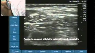 Ultrasound location of lateral femoral cutaneous nerve