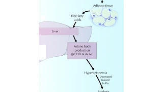 Diabetic Ketoacidosis (DKA)