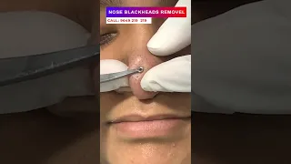 Nose blackheads removal at skinaa clinic | Viral #shorts