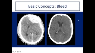 Tomography- Introduction to CT Head  Approach and Principles-What the Radiologist should know