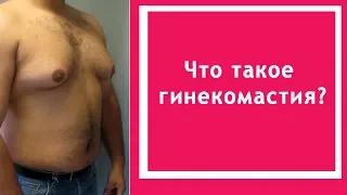 Что такое гинекомастия?