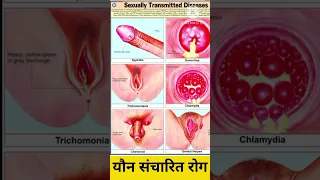 sexually Transmitted Diseases (STDs),  यौन संचारित रोग , cause , signs and symptoms,  diagnosis.....