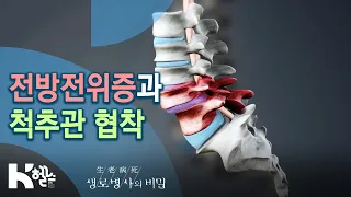 전방전위증과 척추관 협착 - 몸 꼿꼿이 사는 법 (KBS_747회_2020.09.30 방송)
