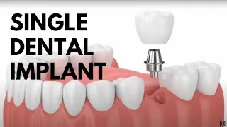 Single Dental Implant Procedure Animated