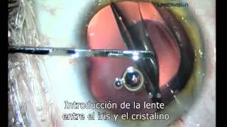 Lente intraocular para el tratamiento de la miopia hipermetropia y astigmatismo