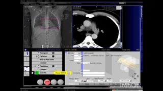 Angiotac Arterias Coronarias Siemens Somatom 64 multidetectores