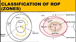 ZONES IN RETINOPATHY OF PREMATURITY ( ROP)