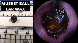 Musket Ball Ear Wax Removal (With Smiley Face In Wax?)