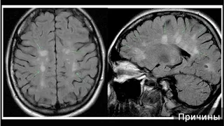 Рассеянный склероз. Как лечить рассеянный склероз.