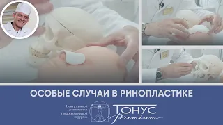 Особые случаи в ринопластике