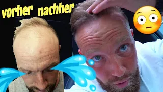 Haartransplantation 8 Monate Ergebnis Vorher Nachher 😱