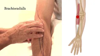 How To Treat Trigger Points - Brachioradialis