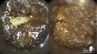 148 - Unbelievable Amount of Ear Wax Removal from Crying 7 Year Old Child using the WAXscope®️