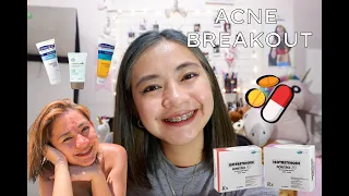 Clear Skin Journey: My Acne Treatment Experience with Isotretinoin | Ria Ebueza ♥