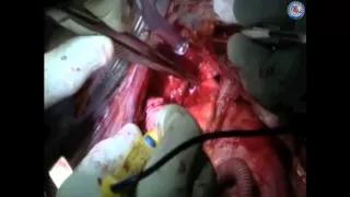 Continuous perfusion “Branch-first” aortic arch replacement: a technical perspective